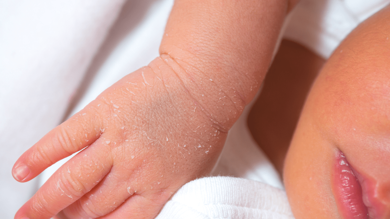 What's Normal of Newborn's Skin