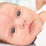 Babies and Skin Allergies