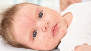 Babies and Skin Allergies