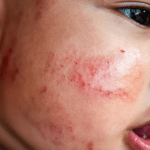 Baby's Eczema Care Tips