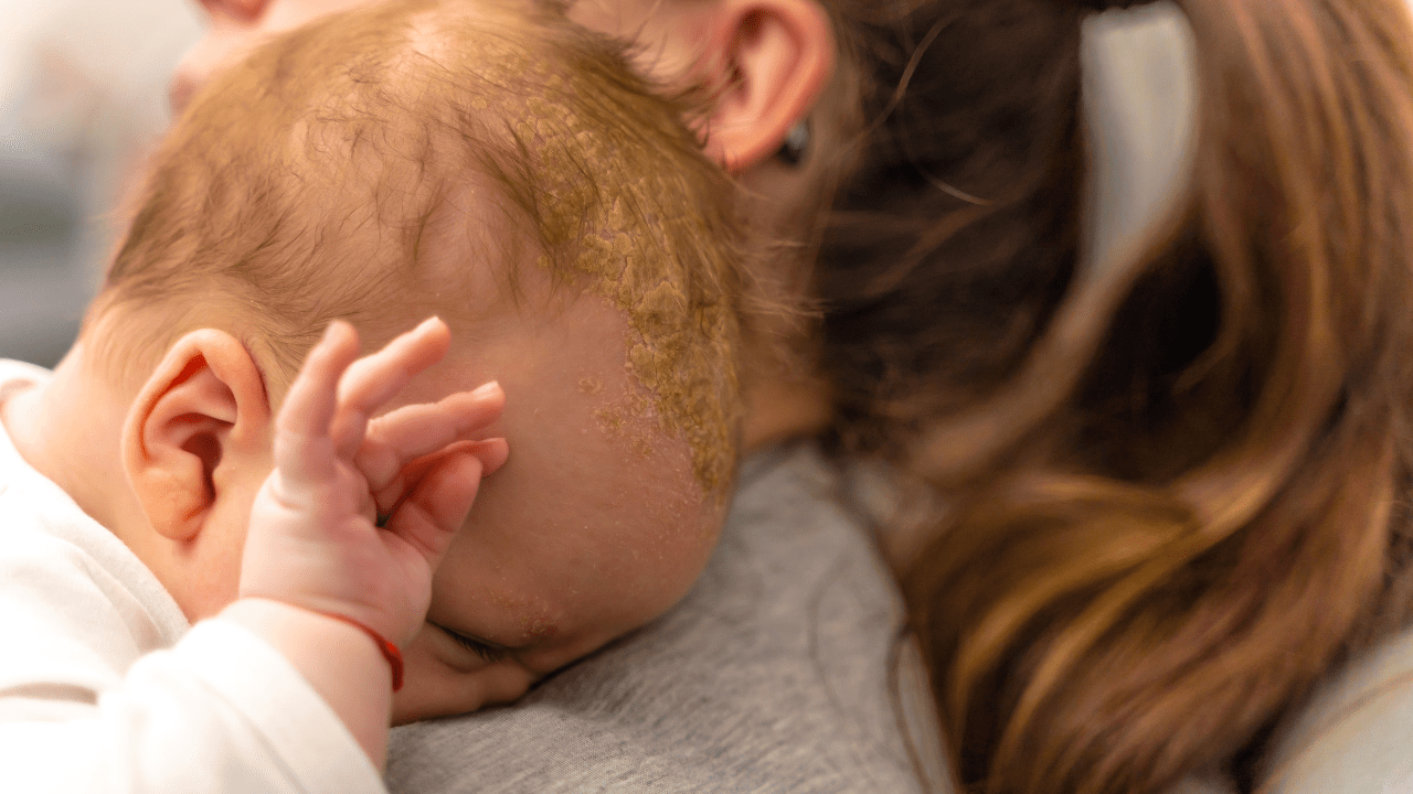 Cradle Cap Treatment