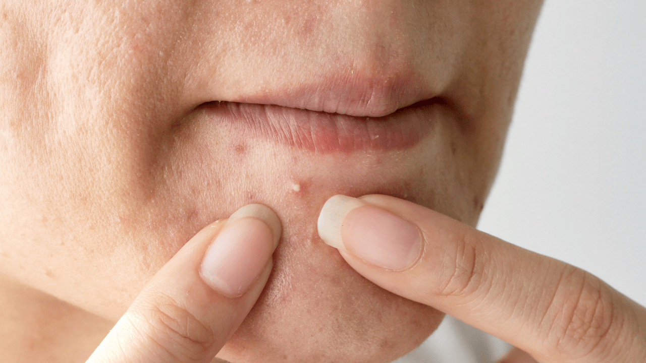 Menopausal Acne