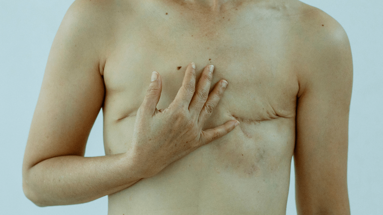 Mastectomy Acceptance