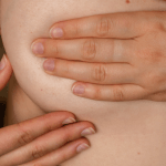 Breast Cancer Symptoms that aren't Lumps